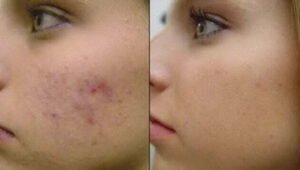 akne-4509930