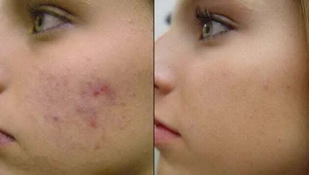 akne-6929587