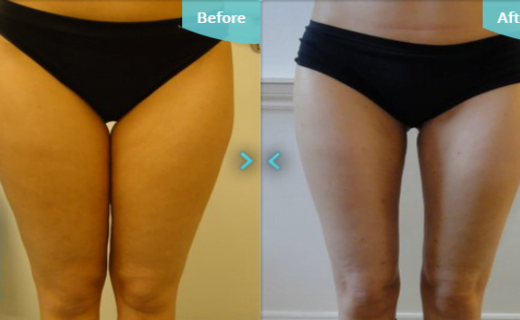 noge-520x320-1573250