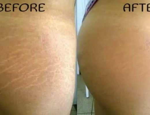 stret-520x400-9471277