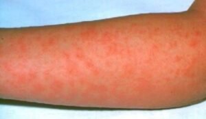 m260054-scarlet_fever_rash_on_a_patients_arm_342x198-1616461