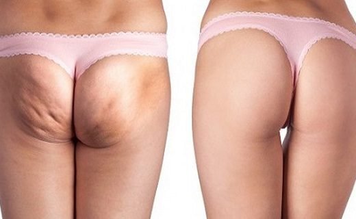 say-goodbye-to-cellulite-forever-520x320-8852302
