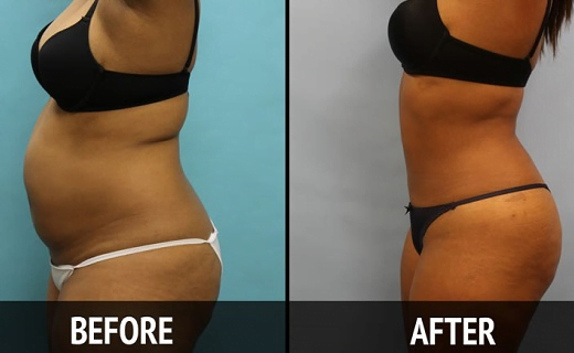 the-most-powerful-drink-for-a-flat-belly-in-just-7-days-520x320-7453217