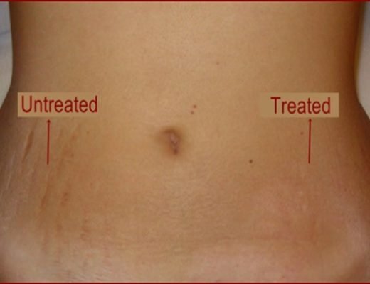 belco-5-520x400-3707026